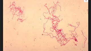 Chancroid and Syphilis: Most Important Points for USMLE