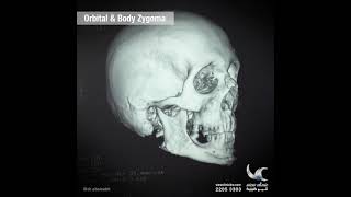 orbital \u0026 body zygoma