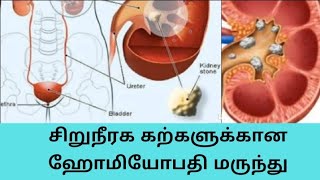 KEDNEY STONE! சிறுநீரக கற்களுக்கான ஹோமியோபதி மருந்து! DR.SURYA SARAVANAA IN TAMIL