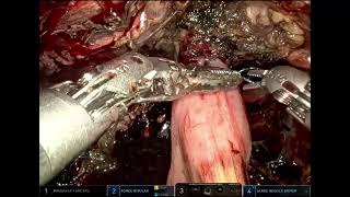 Robotic Intracorporeal Ileal Neobladder - Our Modification of the Karolinska Institute Technique