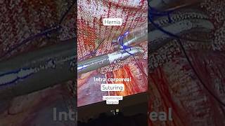 Intra corporeal Suturing I Laparoscopic Suture Fixation of Hernia Mesh I Umbilical Ventral Hernia