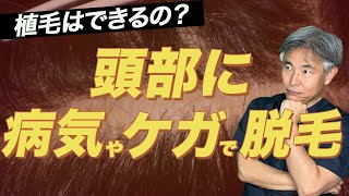 【視聴者さんからの質問】瘢痕部位（傷など）に植毛ができるのか？専門医が解説します！