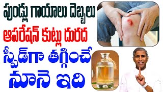 పుండ్లు, గాయాలు, దెబ్బలు, ఆపరేషన్ కుట్లు స్పీడ్ గా తగ్గించే నూనె ఇది| Dr Manthena Satyanarayana Raju