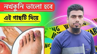 নখকুনি ভালো করুন চিরতরে | ইউনানী দাওয়াখানা | Unanidawakhana