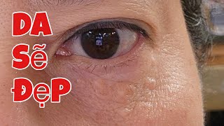 Cách trị mụn thịt xung quanh mắt, trán và cổ hiệu quả tuyệt vời | How to treat syringomas under eyes