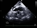 Large effusion, no tamponade