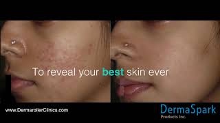 How eDermaStamp by Dermaroller® Works