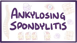 Ankylosing spondylitis - causes, symptoms, diagnosis, treatment, pathology