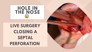 HOLE IN THE NOSE 😱 Live surgery - closing of a septal perforation 🫣👃