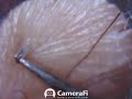 circular and curly ingrown hair removed 48