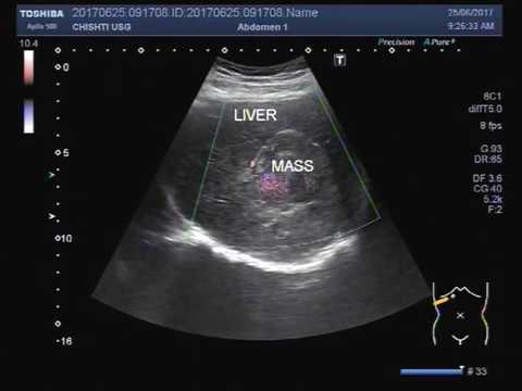 Ultrasound Video Showing A Mass In Liver Youtube