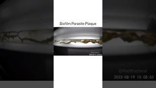 removal of parasites, biofilm and mucoid plaque- #parasite #intestinalworms #colonicirrigation