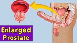 How To Diagnose Enlarged Prostate At Home  | Doctor explain