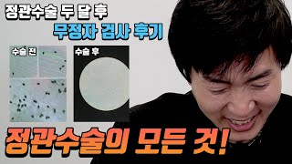 정관수술의 모든 것! 콘돔없는 부부관계, 좋은 남편 되는방법 2탄!![성기능,임신가능성,발기부전]