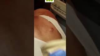 Huge Blackheads Extraction Big Cystic Pimple Blackheads\u0026Whiteheads Removal Popping #746 #Shorts