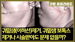 침샘제거(귀밑샘_이하선)나 침샘 보톡스(귀밑샘, 턱밑샘) 받아도 문제없을까?