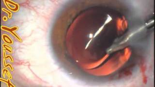 ZCB00 Haptic in the sulcus corrected.mp4