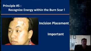 Pediatric Trauma 2014 Video 10 - Burn Injury -- Reconstruction