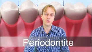 Periodontite