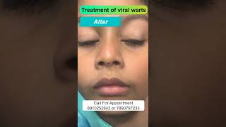 Treatment of viral warts | আঁচিল চিকিৎসা / मस का इलाज / লেজার চিকিৎসা Dr. Uttam Kumar Lenka