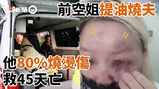 前空姐提油燒夫！火勢蔓延害己毀容　老公80%嚴重燒燙傷亡｜台中｜口角｜縱火｜看新聞