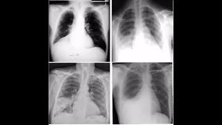 ATELECTASIE,PLEURESIE,PNEUMONIE OU INFARCTUS du poumon  ?!