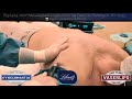 male breast gynecomastia revision hi def vaser liposculpture surgery long island ny by dr lebowitz