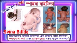 Spina Bifida, Rehabilitation result- My Physio BD, Chattogram, Bangladesh