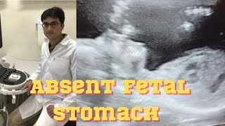 Sonography/absent fetal stomach