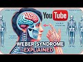 Weber's Syndrome/ Overview/Quick Learning