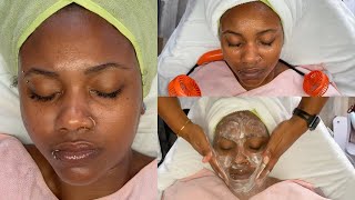 Facial To Correct Texture \u0026 Hyperpigmentation | Skin of Color