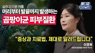 [메디컬 라이브] 습하고 더운 여름, 머리부터 발끝까지 발생하는 곰팡이균 피부질환!ㅣ메디컬 인사이트 / YTN2U