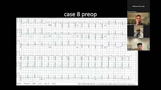 Left Bundle Branch Pacing Webinar, Session 3