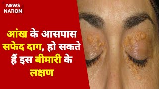 आंख के आसपास सफेद दाग, हो सकते हैं इस बीमारी के लक्षण Health Tips |