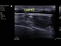 POCUS Case - Rib Fracture