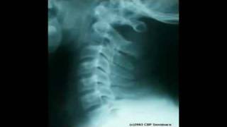 Time-Lapsed Disc Degeneration of the Neck - Mississauga Pain Clinic