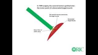 Neuroma Prevention