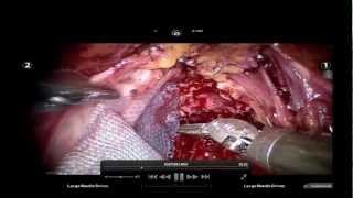 Nerve Sparing Robotic Prostatectomy with Novel Use of an Amnion Adhesion Barrier