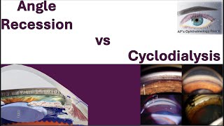 Angle Recession vs Cyclodialysis