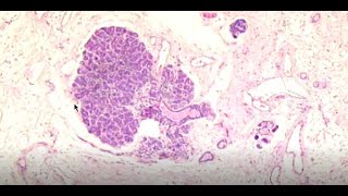 Pathology Malignant Epithelial Tumours 3  Benign Mesenchymal Tumours