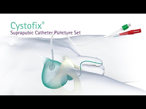 Cystofix Suprapubic Catheter Puncture Set - YouTube