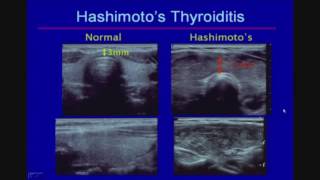 Sonographic Evaluation of Diffuse Thyroid Disease