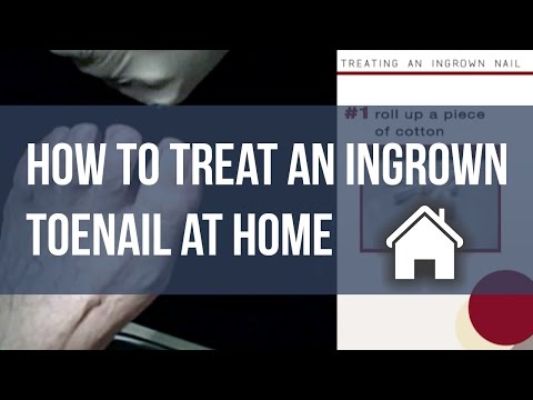 How do you numb a bruised toenail?