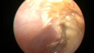 CHRONIC SUPPURATIVE OTITIS MEDIA WITH ATTIC PERFORATION