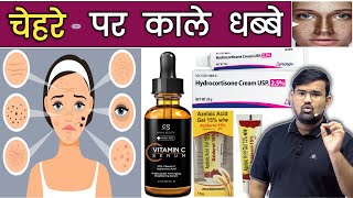 Melasma - चेहरे पर काले धब्बे | Medicine | Treatment | Doctor | Pharmacy | Nursing | MBBS | BHMS