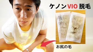 ケノンでメンズの剛毛VIOは脱毛できるのか？ケノンVIO脱毛の経過