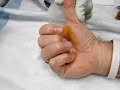 trigger finger surgery percutaneous trigger release dr. alejandro badia