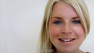 Invisalign Funciona Mesmo