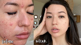 My Accutane Journey | Raw Footage Before and After