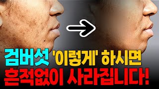 검버섯 없애는 유일한 방법은 딱 ‘이것’ 뿐입니다. 검버섯과 기미를 예방하고 피부건강에 좋은 음식 3가지와 피해야 할 음식, 그리고 특급 천연 마스크팹 레시피